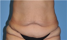 Tummy Tuck Before Photo by Robert Wilcox, MD; Plano, TX - Case 31828