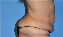 Tummy Tuck Before Photo by Robert Wilcox, MD; Plano, TX - Case 31828