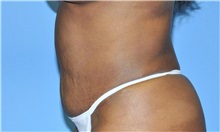 Liposuction After Photo by Robert Wilcox, MD; Plano, TX - Case 33099