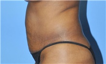 Liposuction Before Photo by Robert Wilcox, MD; Plano, TX - Case 33099