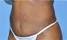 Liposuction After Photo by Robert Wilcox, MD; Plano, TX - Case 33099
