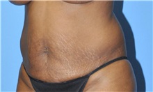 Liposuction Before Photo by Robert Wilcox, MD; Plano, TX - Case 33099