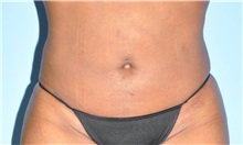 Liposuction After Photo by Robert Wilcox, MD; Plano, TX - Case 33709