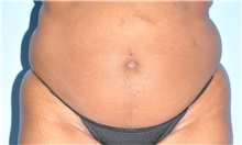 Liposuction Before Photo by Robert Wilcox, MD; Plano, TX - Case 33709