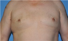 Male Breast Reduction After Photo by Robert Wilcox, MD; Plano, TX - Case 33710