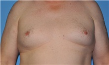 Male Breast Reduction Before Photo by Robert Wilcox, MD; Plano, TX - Case 33710