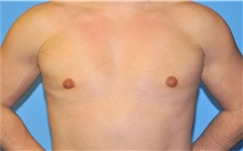 Male Breast Reduction After Photo by Robert Wilcox, MD; Plano, TX - Case 35504