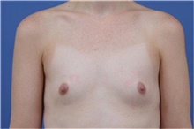 Breast Augmentation Before Photo by Amy Simon, MD, FACS; Saint Petersburg, FL - Case 49027