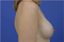 Breast Augmentation After Photo by Amy Simon, MD, FACS; Saint Petersburg, FL - Case 49027