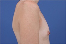 Breast Augmentation Before Photo by Amy Simon, MD, FACS; Saint Petersburg, FL - Case 49027