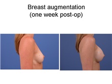Breast Augmentation After Photo by Amy Simon, MD, FACS; Saint Petersburg, FL - Case 49029