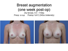 Breast Augmentation Before Photo by Amy Simon, MD, FACS; Saint Petersburg, FL - Case 49029