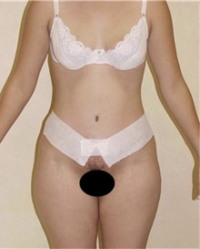 Tummy Tuck After Photo by Kimberly Henry, MD; Greenbrae, CA - Case 38456