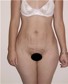 Tummy Tuck Before Photo by Kimberly Henry, MD; Greenbrae, CA - Case 38456
