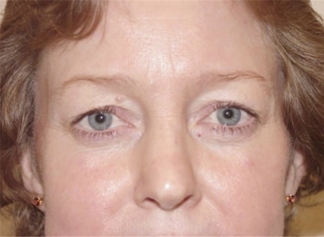 Eyelid Surgery Before And After Photos By Kimberly Henry, MD; Greenbrae ...