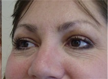 after eyelid surgery