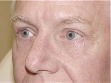 Eyelid Surgery After Photo by Kimberly Henry, MD; Greenbrae, CA - Case 38492