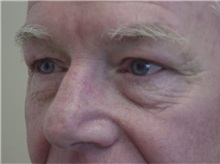Eyelid Surgery Before Photo by Kimberly Henry, MD; Greenbrae, CA - Case 38492