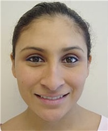 Rhinoplasty Before Photo by Kimberly Henry, MD; Greenbrae, CA - Case 38494