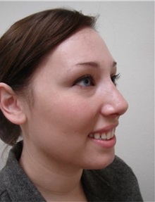 Rhinoplasty After Photo by Kimberly Henry, MD; Greenbrae, CA - Case 38498