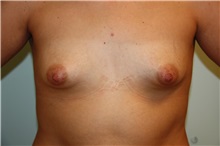 Breast Augmentation Before Photo by Luis Vinas, MD, FACS; West Palm Beach, FL - Case 30731