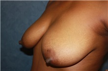 Breast Lift Before Photo by Luis Vinas, MD, FACS; West Palm Beach, FL - Case 30742