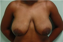 Breast Reduction Before Photo by Luis Vinas, MD, FACS; West Palm Beach, FL - Case 30755