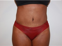 Liposuction After Photo by Luis Vinas, MD, FACS; West Palm Beach, FL - Case 30764