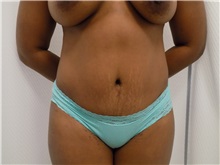 Liposuction Before Photo by Luis Vinas, MD, FACS; West Palm Beach, FL - Case 30764