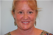 Facelift After Photo by Luis Vinas, MD, FACS; West Palm Beach, FL - Case 30774