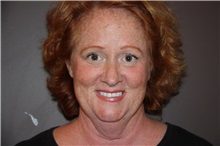Facelift Before Photo by Luis Vinas, MD, FACS; West Palm Beach, FL - Case 30774