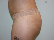 Buttock Lift with Augmentation After Photo by Luis Vinas, MD, FACS; West Palm Beach, FL - Case 32097