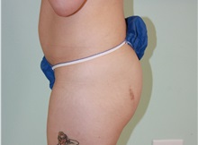 Buttock Lift with Augmentation Before Photo by Luis Vinas, MD, FACS; West Palm Beach, FL - Case 32097