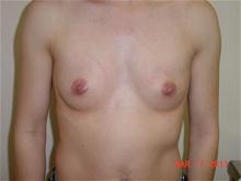 Breast Augmentation Before Photo by Kimberley B. C. Goh, MD; Myrtle Beach, SC - Case 28666