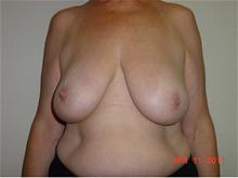Breast Lift Before Photo by Kimberley B. C. Goh, MD; Myrtle Beach, SC - Case 28675