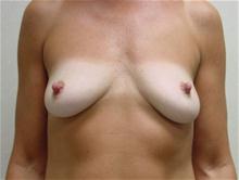 Breast Augmentation Before Photo by Kimberley B. C. Goh, MD; Myrtle Beach, SC - Case 28682