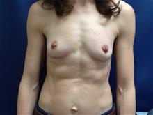 Breast Augmentation Before Photo by Kimberley B. C. Goh, MD; Myrtle Beach, SC - Case 29227