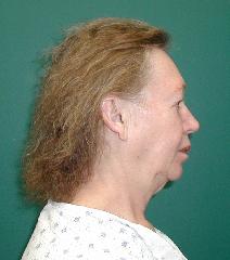Facelift Before Photo by Guy Stofman, MD; Pittsburgh, PA - Case 8807