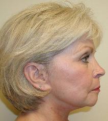Facelift After Photo by Guy Stofman, MD; Pittsburgh, PA - Case 8809