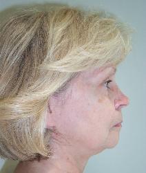 Facelift Before Photo by Guy Stofman, MD; Pittsburgh, PA - Case 8809
