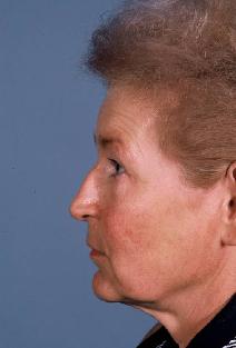 Facelift Before Photo by Guy Stofman, MD; Pittsburgh, PA - Case 8810