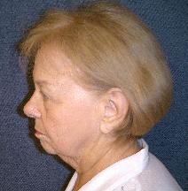 Facelift Before Photo by Guy Stofman, MD; Pittsburgh, PA - Case 8811