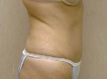 Tummy Tuck After Photo by Craig Creasman, MD; Los Gatos, CA - Case 7168