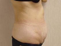 Tummy Tuck Before Photo by Craig Creasman, MD; Los Gatos, CA - Case 7168