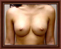 Breast Augmentation After Photo by Craig Creasman, MD; Los Gatos, CA - Case 7178