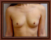 Breast Augmentation Before Photo by Craig Creasman, MD; Los Gatos, CA - Case 7178