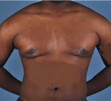 Male Breast Reduction After Photo by Thomas Hubbard, MD; Virginia Beach, VA - Case 32811