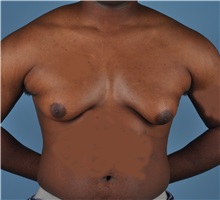 Male Breast Reduction Before Photo by Thomas Hubbard, MD; Virginia Beach, VA - Case 32811