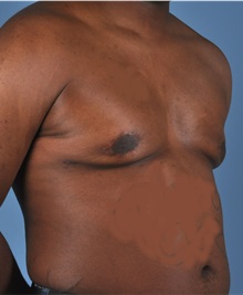 Male Breast Reduction After Photo by Thomas Hubbard, MD; Virginia Beach, VA - Case 32811