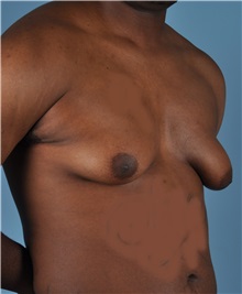 Male Breast Reduction Before Photo by Thomas Hubbard, MD; Virginia Beach, VA - Case 32811